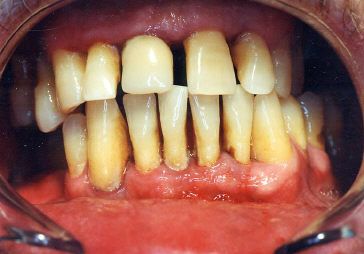 periodontal disease